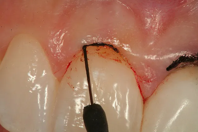 Electrocautery Gum Treatment
