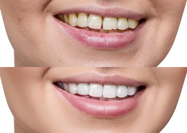 Gap Closure