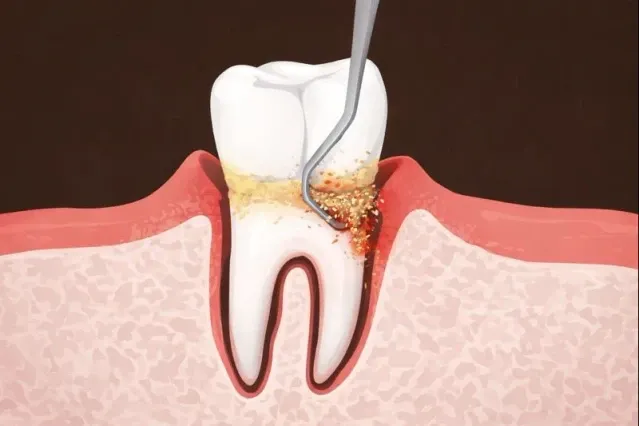 Deep Cleaning