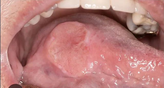 Why Choose Our Oral Cancer Detection