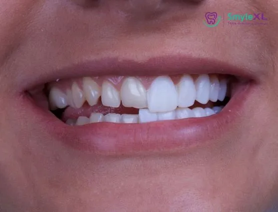 Dental Veneers