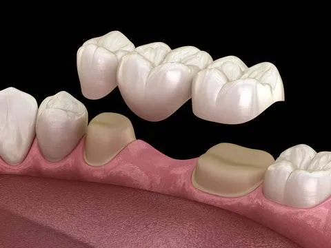 Why Choose Our Crowns & Bridges