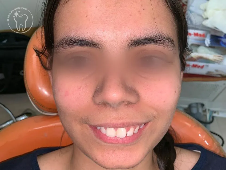 After Treatment