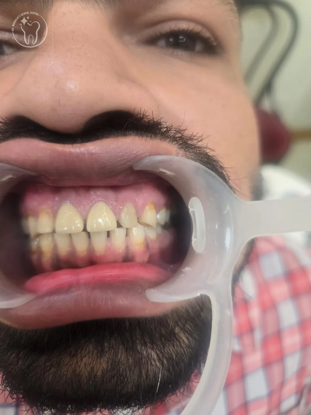 Teeth whitening treatment