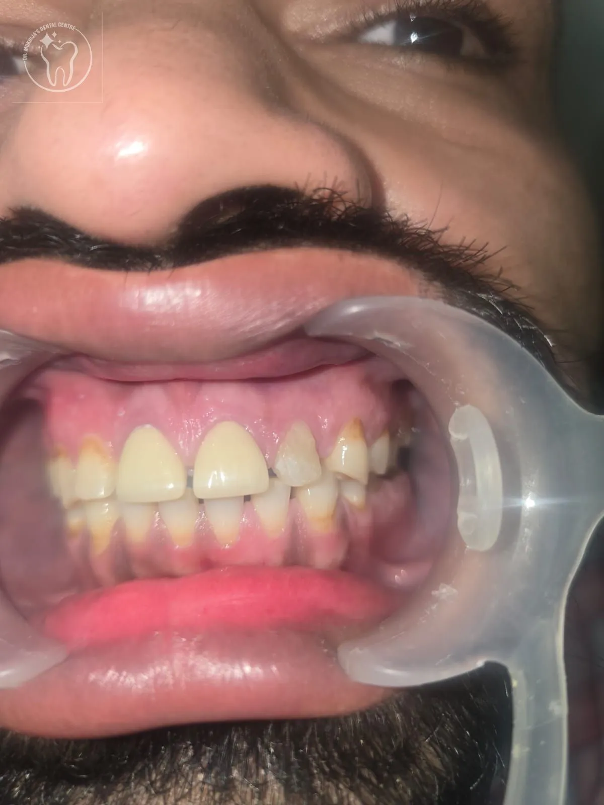 Teeth whitening result