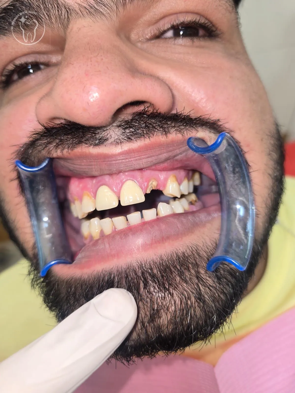 Smile restoration case