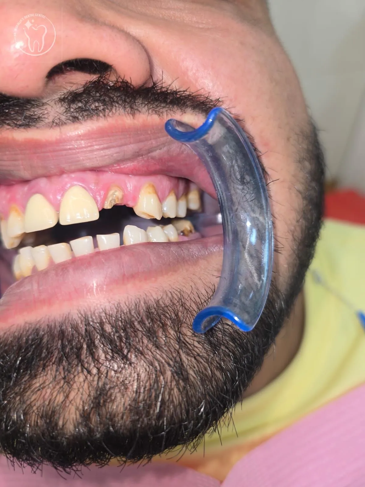 Restorative treatment case