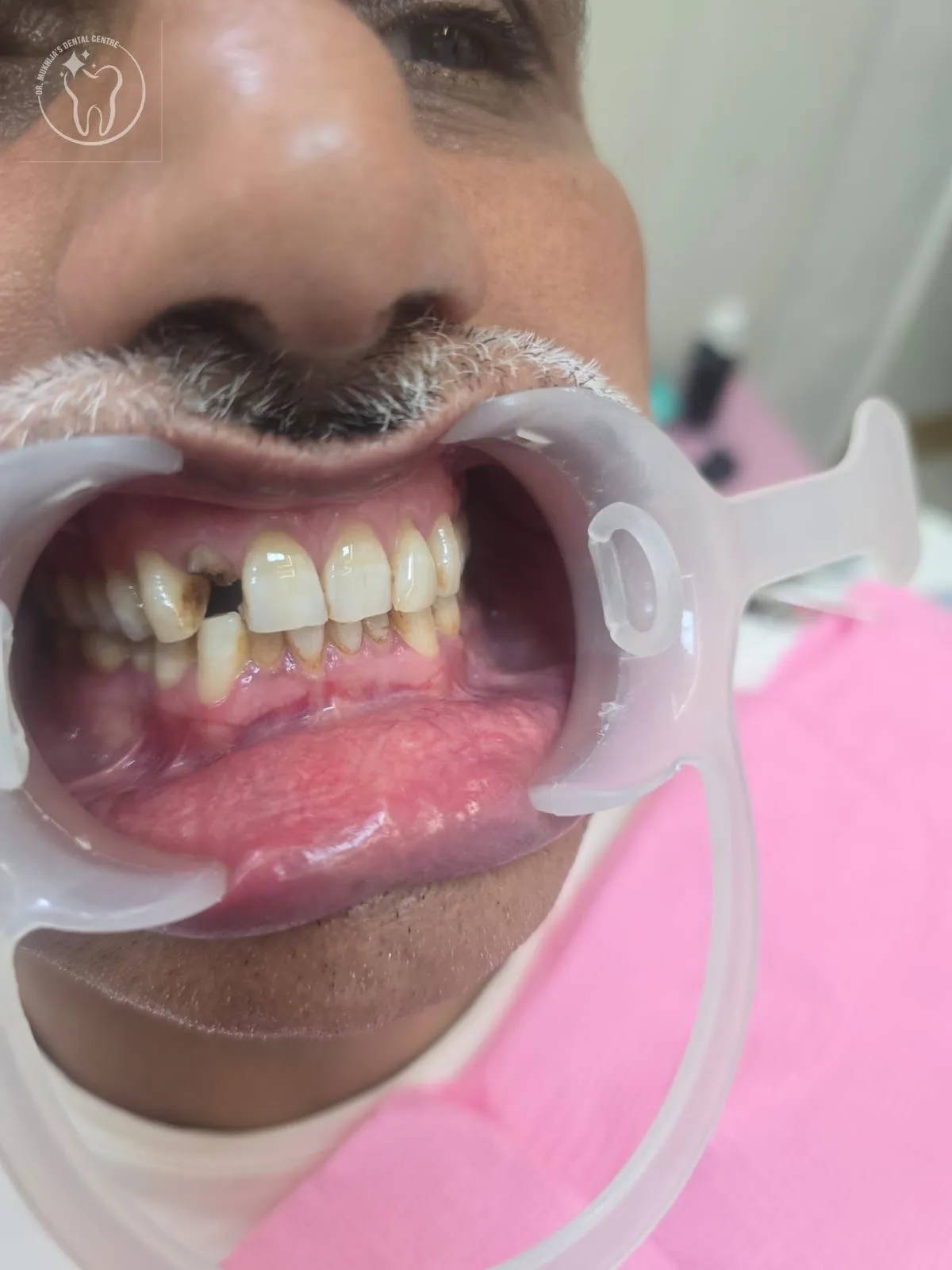 Missing tooth replacement case