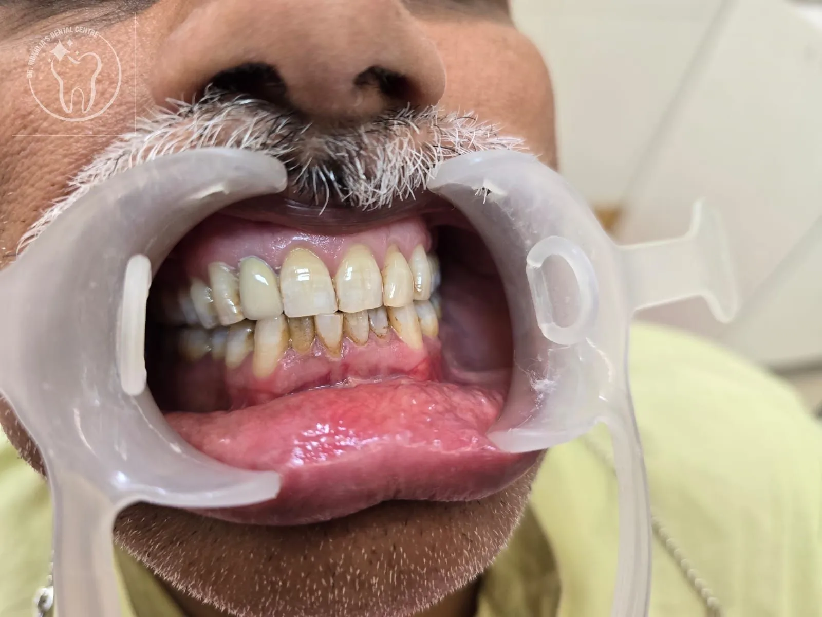 Restored smile after treatment