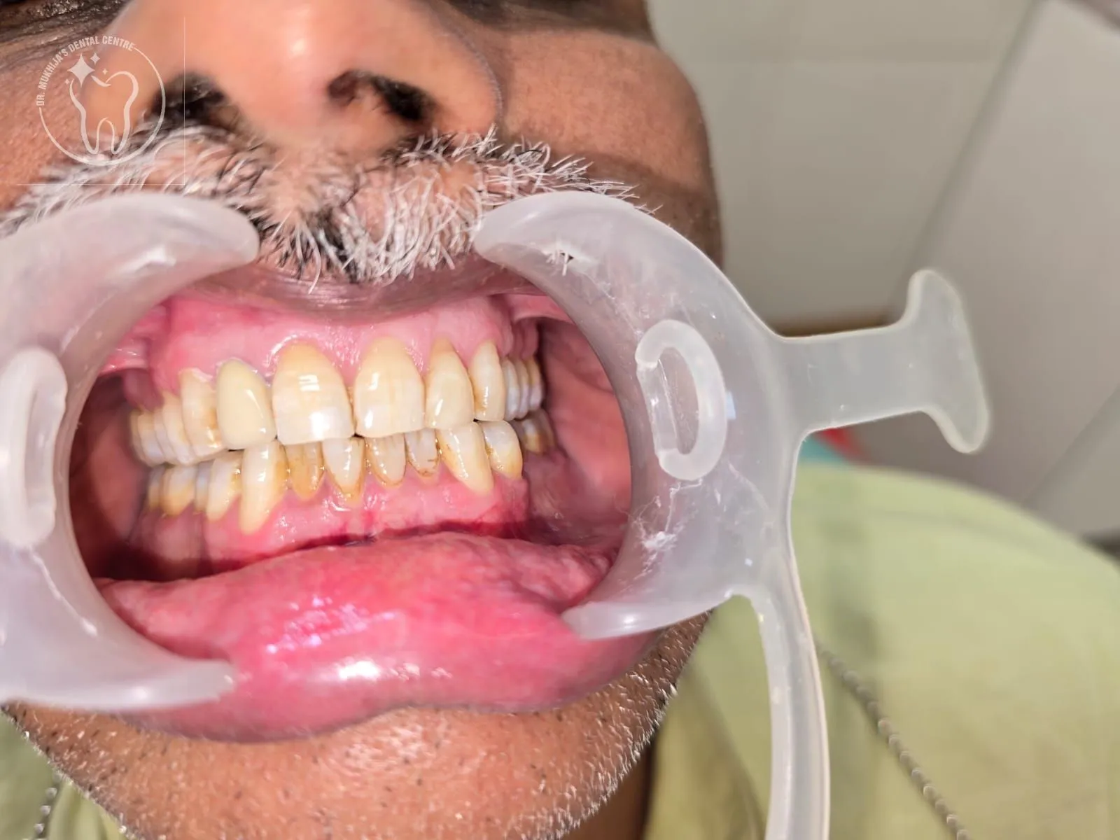 Restored smile after treatment