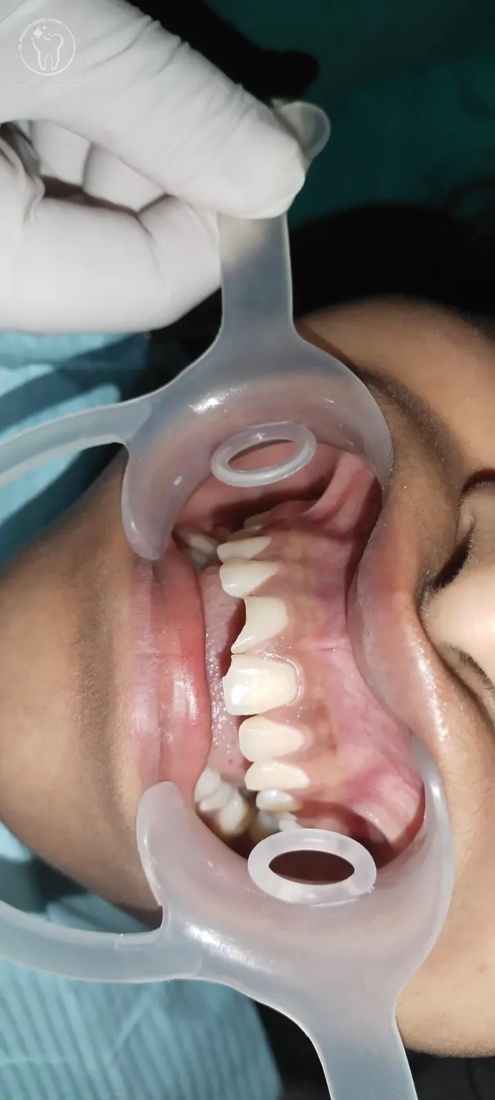 Crown restoration case