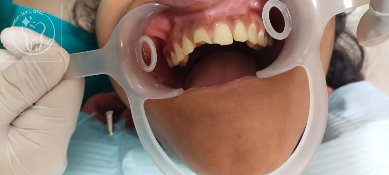 Before treatment case