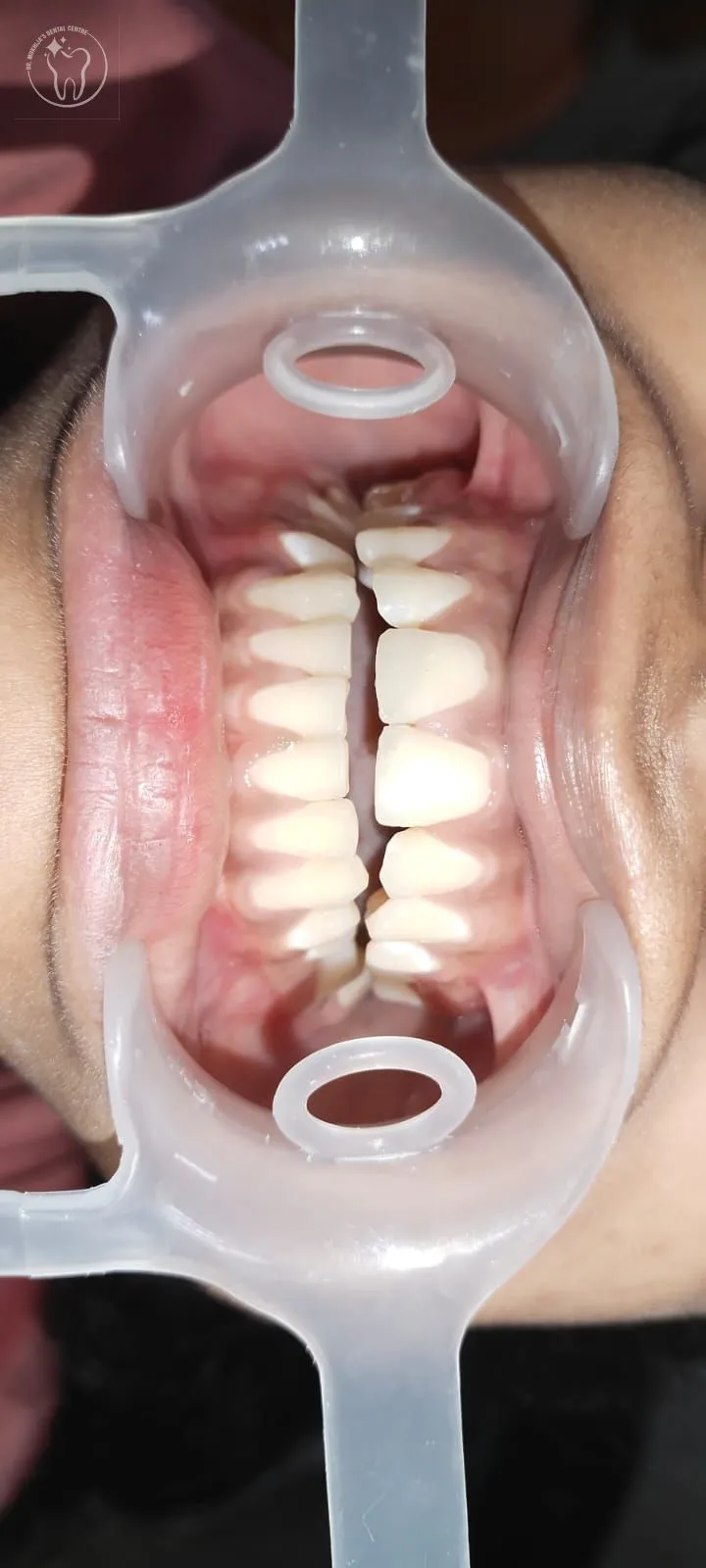 Smile makeover case