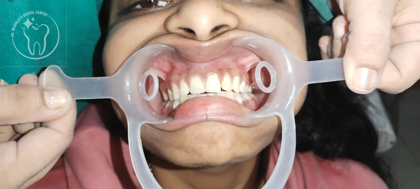 Before tooth replacement