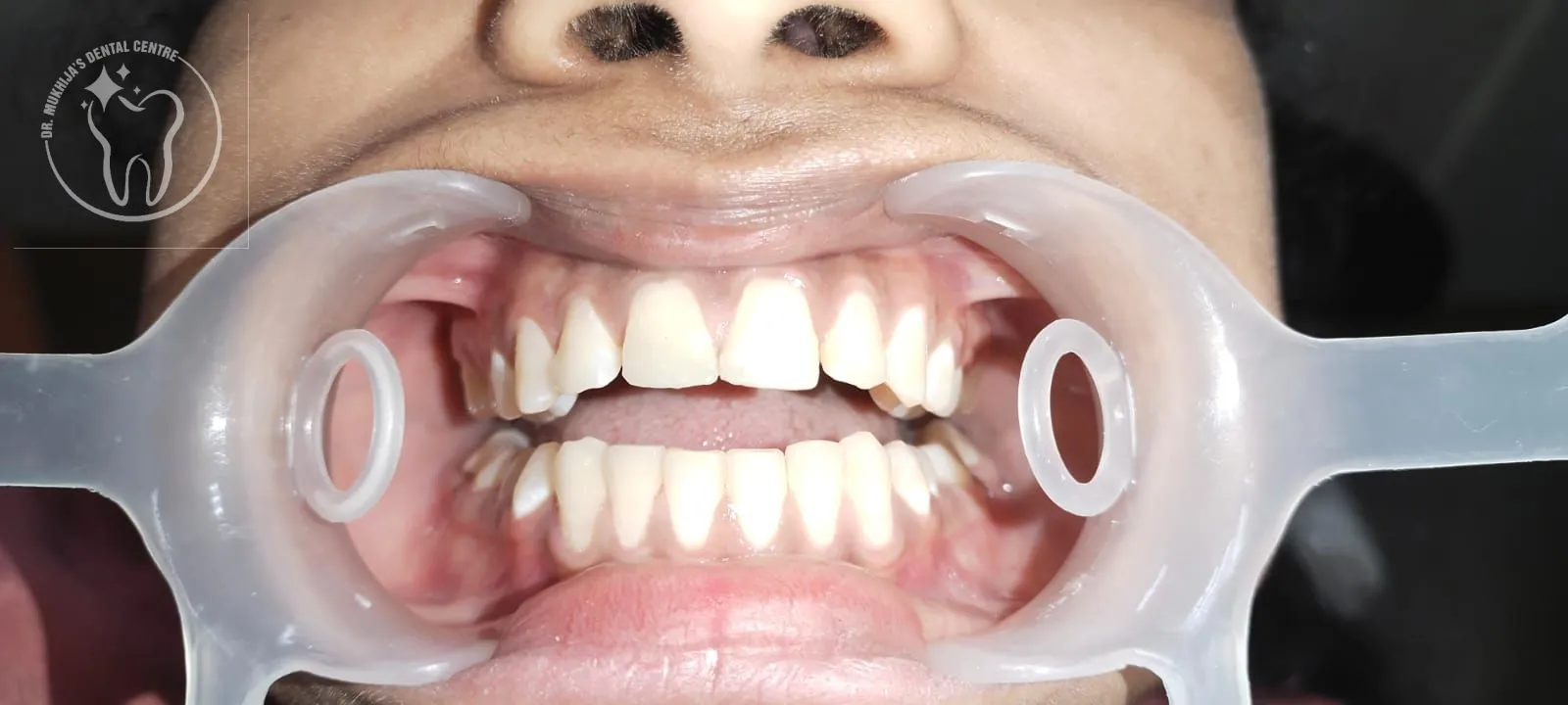 After tooth replacement