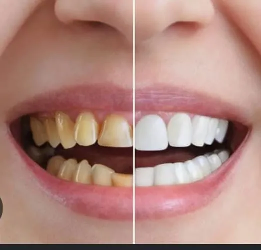 Cosmetic dentistry — dentist applying a porcelain veneer