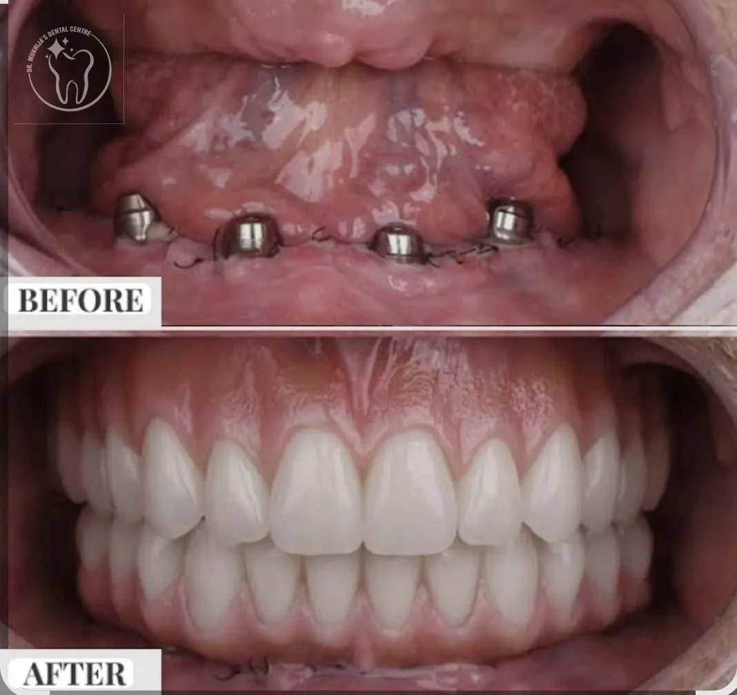 Dental Implant Cost in India: What You're Actually Paying For (And Why Sonipat Is a Smart Place to Get It Done)