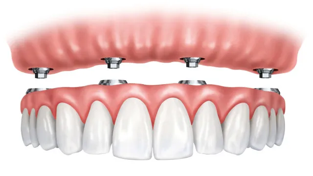 Full Arch Implants