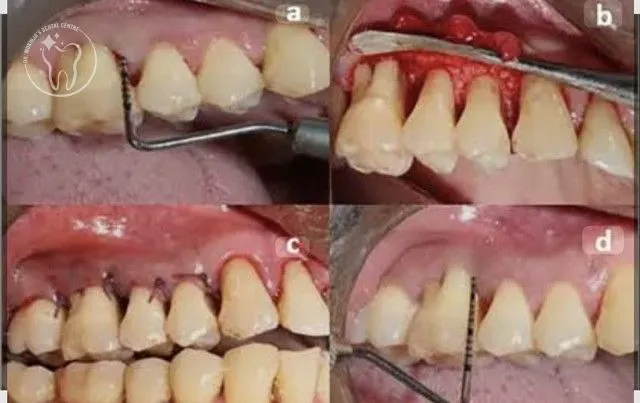 Why Choose Our Gums Treatment