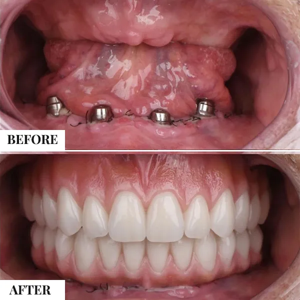 Multiple Teeth Implants