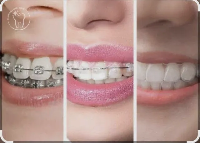 Orthodontics — clear aligner fitting