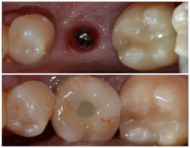 Single Tooth Implant