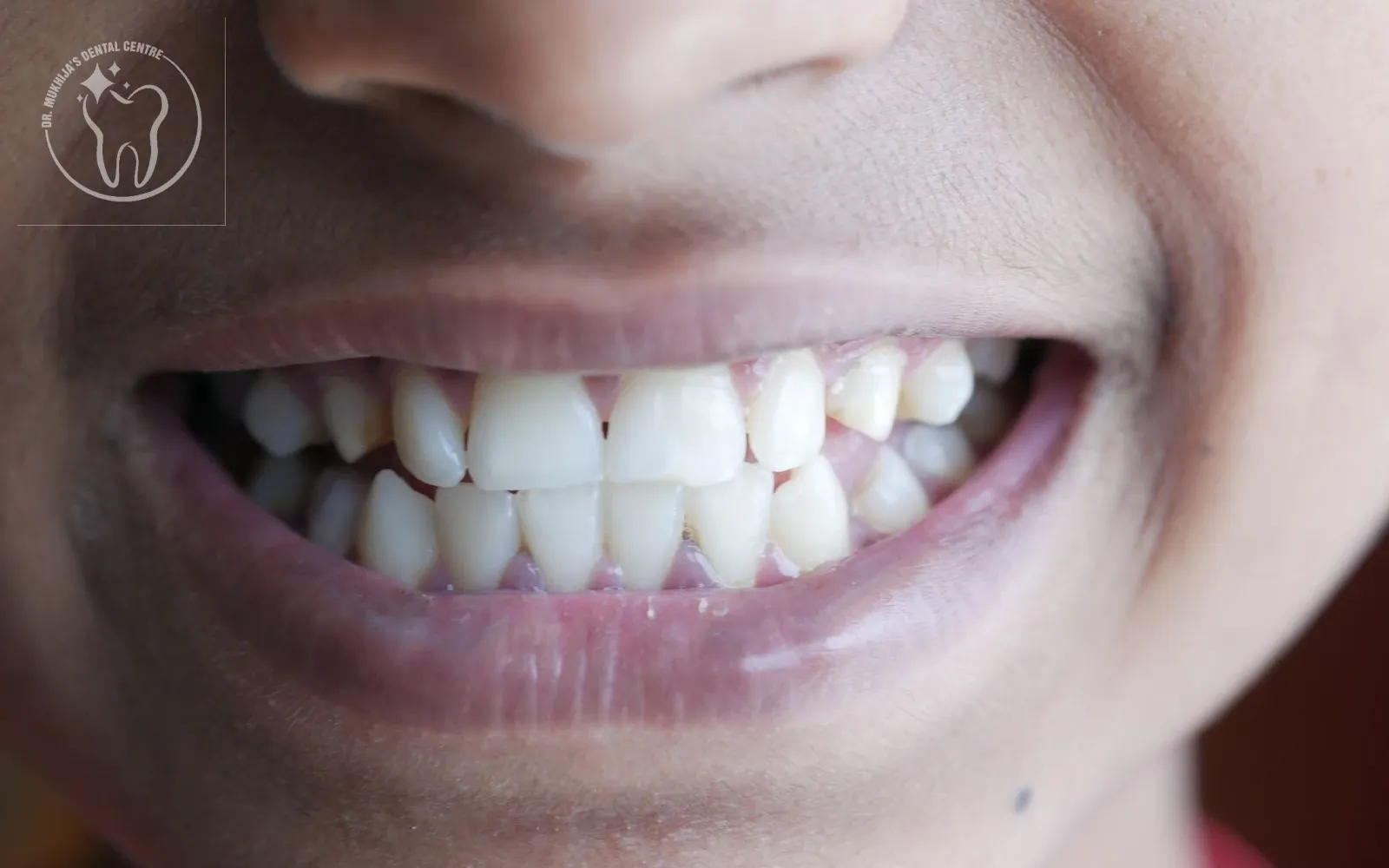 Tooth Sensitivity to Hot and Cold: Causes, Treatment & When to See a Dentist in Sonipat